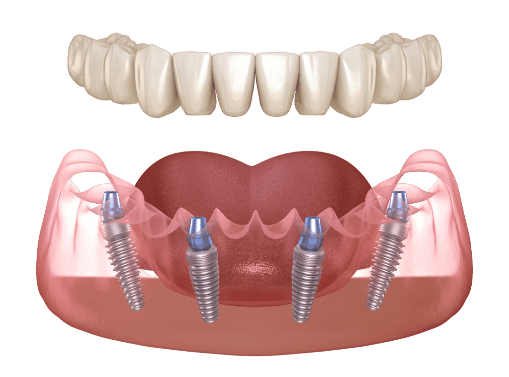 All-on-X: Die innovative Methode für feste Zähne und ein strahlendes Lächeln