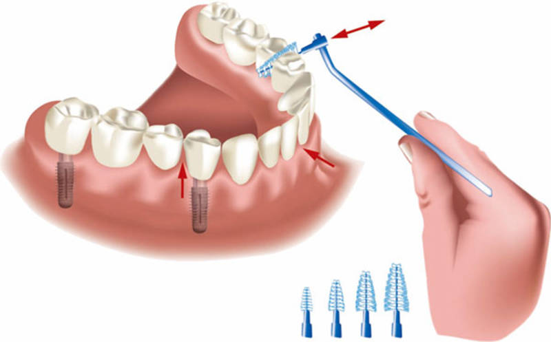 Implantatpflege:  Langlebige Lösung dank Zahnimplantaten